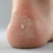 why is the bottom of my foot peeling showing dry peeling skin on sole heel area close up