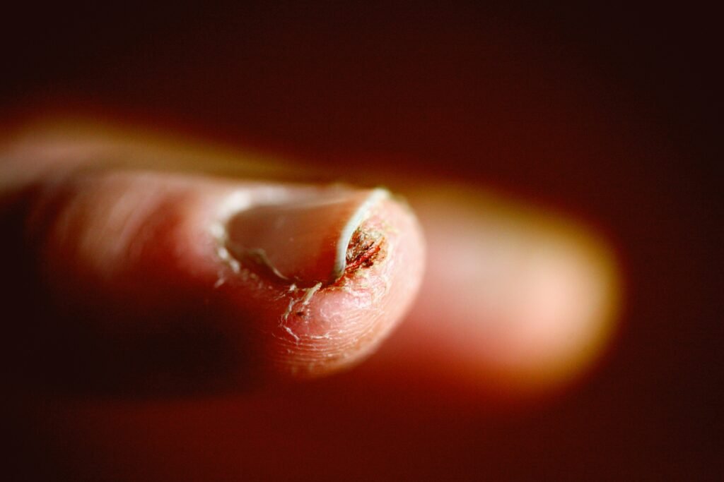 Close-up of a toenail lifted from the nail bed, illustrating why did my toenail fall off without pain.